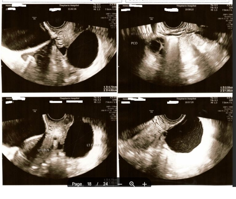 PCOS